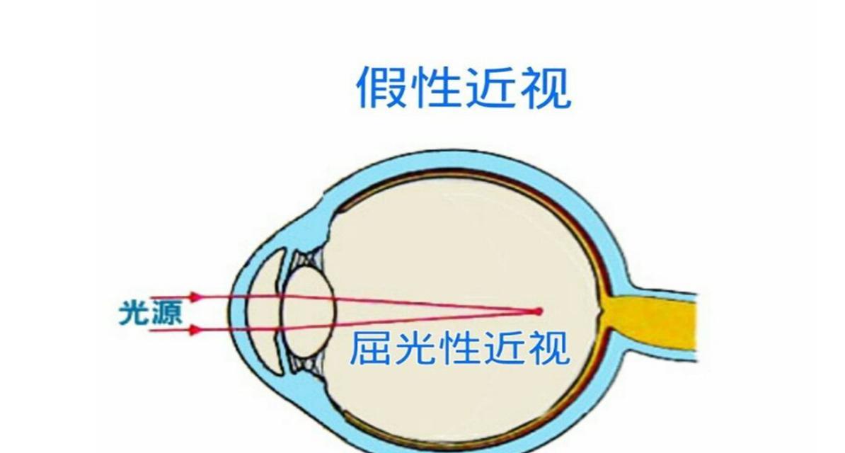 如何治疗假性近视眼（有效方法帮助您摆脱假性近视的困扰）